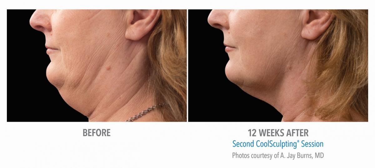 Cool sculpting under chin